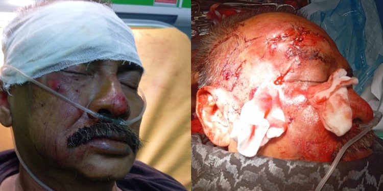 Gegara Tidak Adanya Petugas Khusus Pengamanan Proyek Jalan, H. Budi Rahmadi Tersungkur Luka Parah